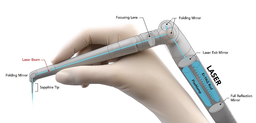エルビウムヤグ(Er:YAG)ライトタッチレーザーハンドピース