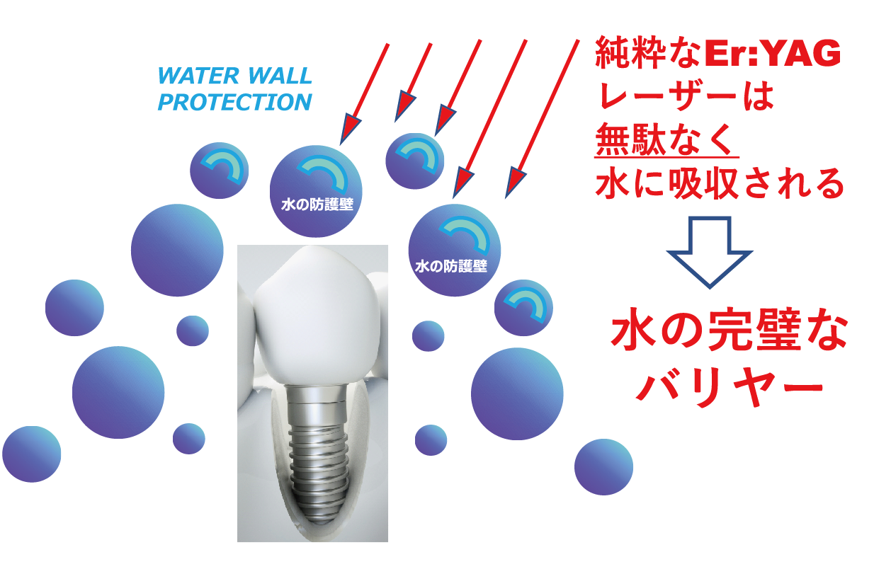 エルビウムヤグ(Er:YAG)ライトタッチレーザーの非侵襲治療